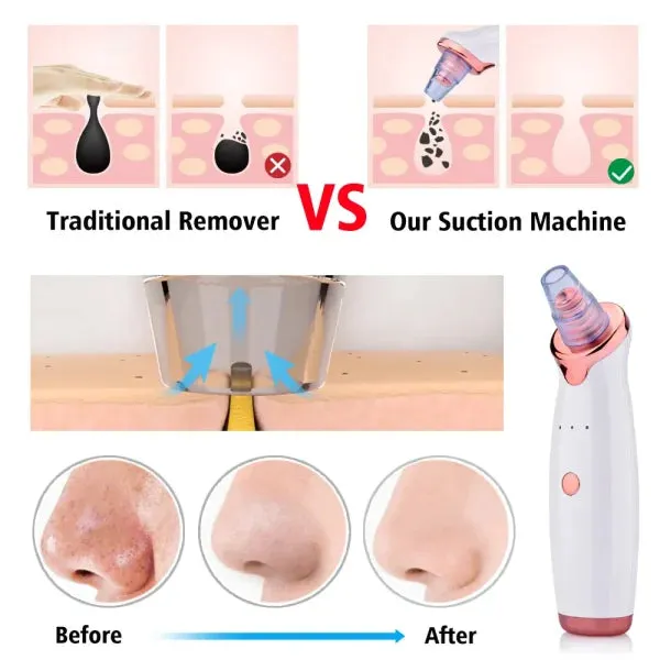 Vacuum Blackhead Remover Face Black Spots Cleaner White Dot Pimple Removal